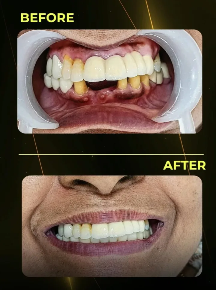 Before and after: mismatched old crowns and missing teeth replaced with a full even smile at The Tooth Corner, Bellandur