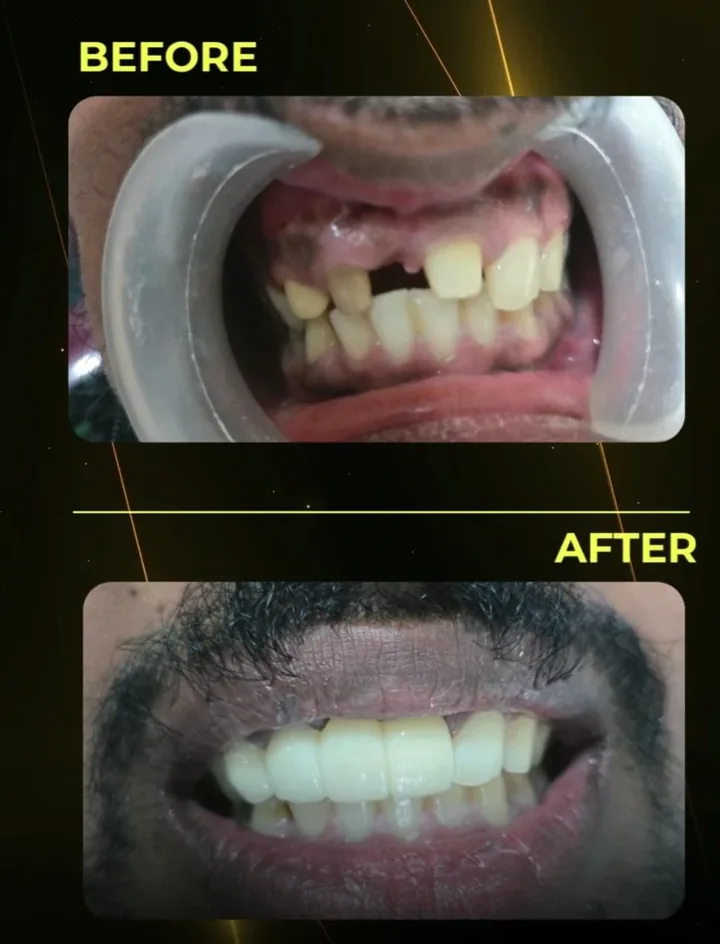 Before and after: a missing upper front tooth replaced at The Tooth Corner, Bellandur