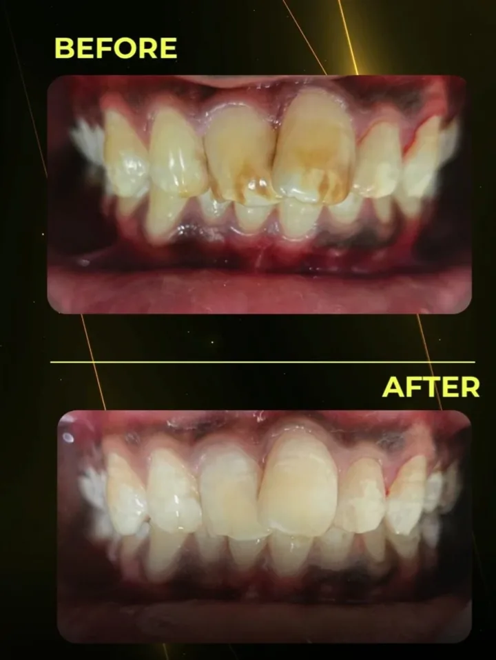 Before and after: brown stained front teeth restored to an even natural shade at The Tooth Corner, Bellandur